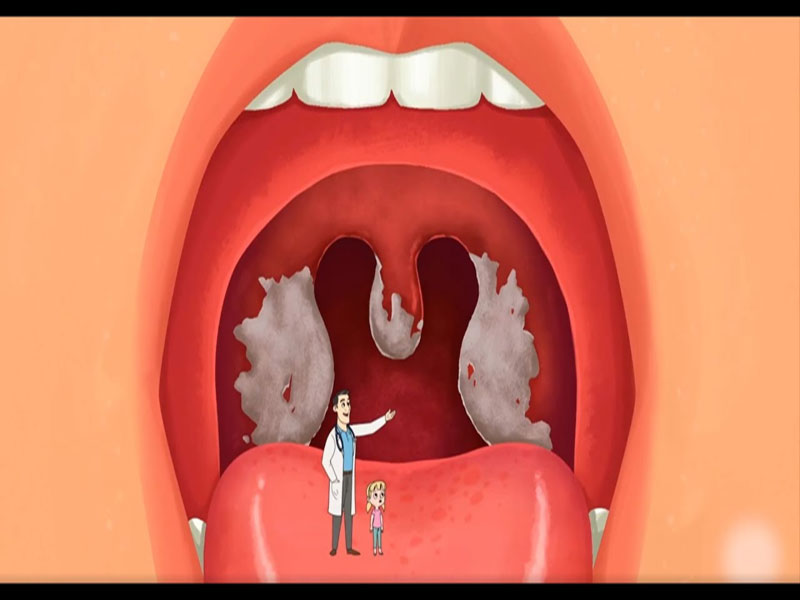 Nệm Ngủ Ngon - Bệnh bạch hầu - Đường lây truyền và cách phòng tránh
