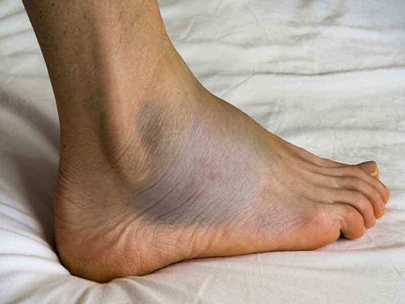 Nệm Ngủ Ngon - Ngủ dậy bị đau bàn chân là dấu hiệu của bệnh gì?