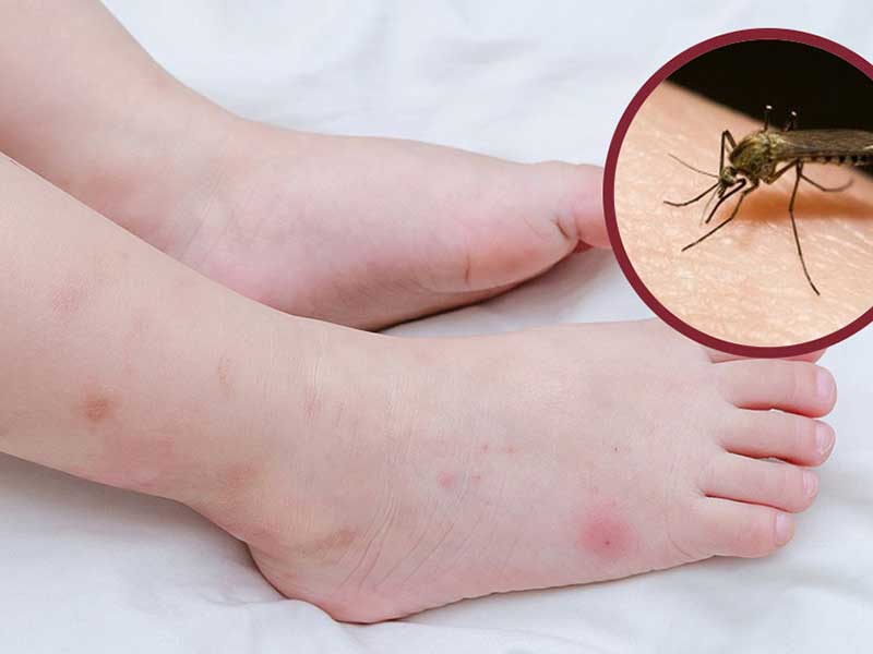 Nệm Ngủ Ngon - Phòng nhiều muỗi phải làm sao?